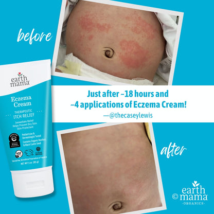 Eczema Cream before and after use